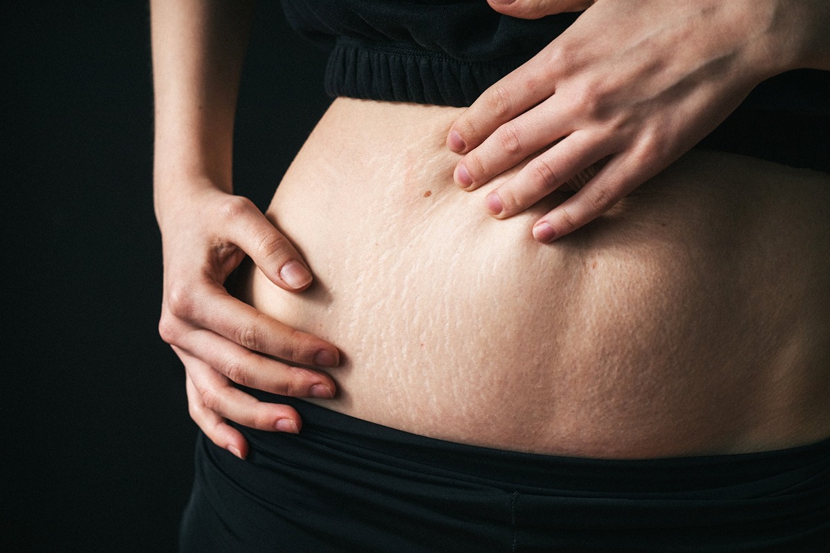 Are Stretch Marks Bad? Exploring the Myths and Facts